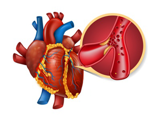 Dyslipidemia